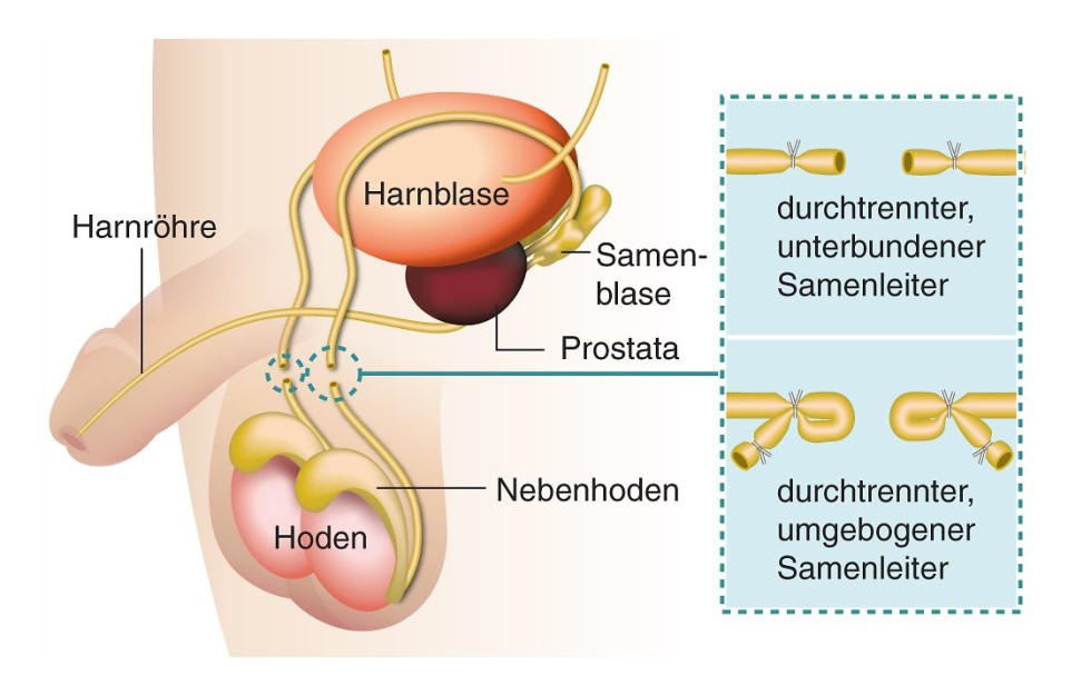 Arten einer Sterilisation